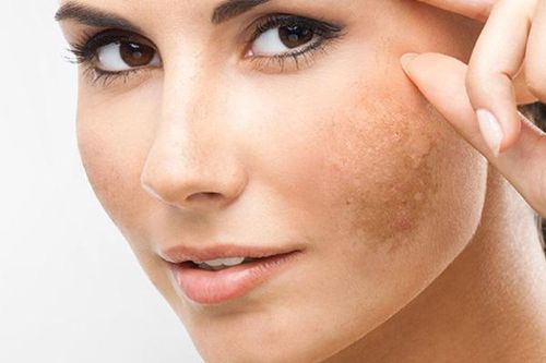 2 cách trị nám da với mật ong bạn không được quên