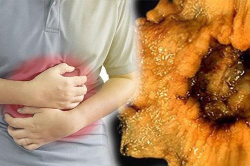 Ung thư dạ dày từ món ăn 'sở trường', 90% người Việt đều mắc phải sai lầm khi ăn món này