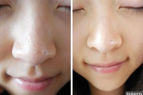 2 cách trị mụn đầu đen tại nhà không phải ai cũng biết