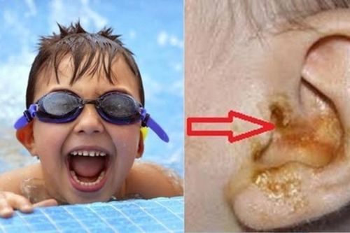 Chuyên gia cảnh báo bệnh tai mũi họng từ những lần đi bể bơi mùa hè