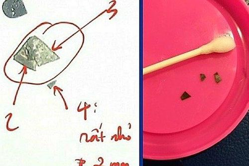 Phát hiện 7 mảnh dao lam trong bụng bé gái 15 tháng tuổi