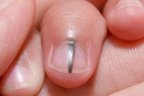 3 bộ phận này chuyển sang màu đen nghĩa là tế bào ung thư đang phát triển trong cơ thể
