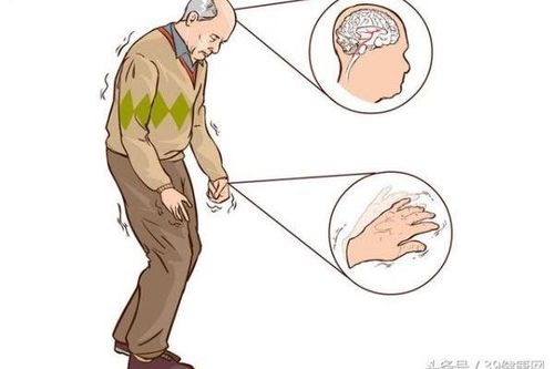 Liệu pháp mới giúp cải thiện chất lượng sống cho bệnh nhân Parkinson
