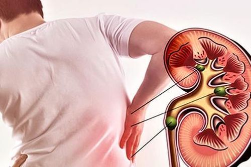 Nguy kịch với những cách trị sỏi thận thiếu an toàn, cách thứ 2 nhiều người gặp phải nhất