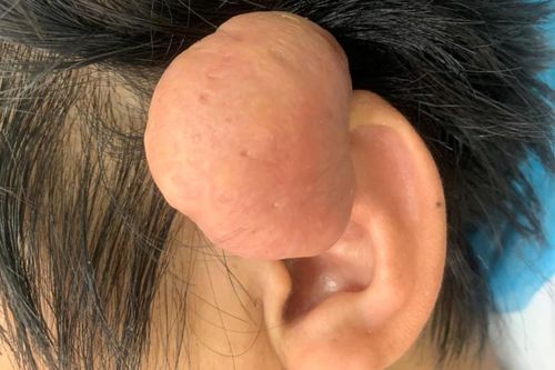 Khối u sụn 'khủng' ở vành tai