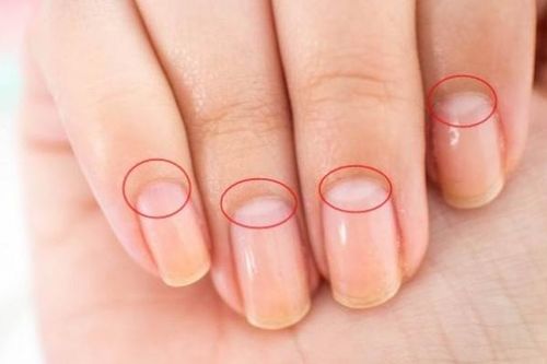 Nhận biết tình trạng sức khỏe qua phần lưỡi liềm màu trắng trên ngón tay