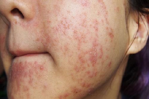 Mụn chi chít vì thói quen tưởng chừng như vô hại
