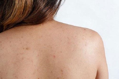 Sạch mụn ở lưng chỉ với 3 nguyên liệu ai cũng kiếm được