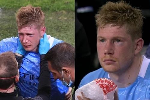 De Bruyne lên bàn mổ, có thể đá EURO 2020 không cần đeo mặt nạ