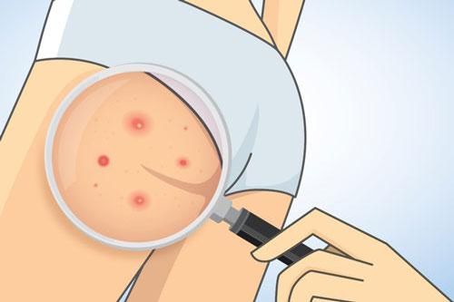 Bí quyết để cả mùa hè mà vòng 3 không hề bị mụn