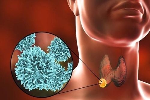 Nguy cơ tái phát bệnh ung thư tuyến giáp nếu người bệnh bỏ theo dõi định kỳ