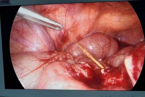 Tăm tre dài 6 cm đâm thủng lòng ruột bệnh nhân 57 tuổi