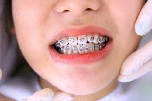 Nữ sinh Trung Quốc suýt không được vào phòng thi vì niềng răng