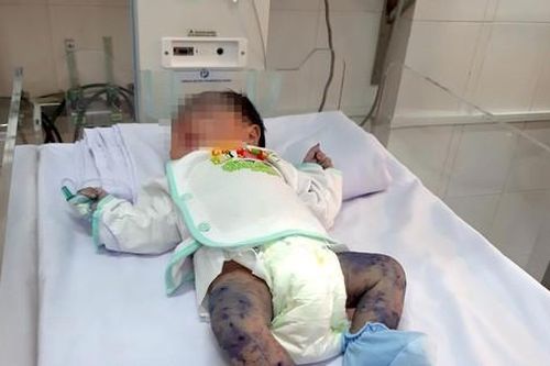 Cứu sống bé trai 13 ngày tuổi bị thủy đậu hiếm gặp
