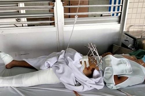 Truy bắt kẻ cướp, một công an xã bị tai nạn nguy kịch