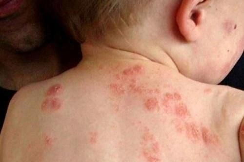 Phòng tránh các bệnh về da trong mùa hè nắng nóng