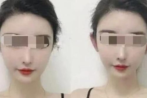 Cơn sốt phẫu thuật để có 'tai yêu tinh' trong giới trẻ Trung Quốc