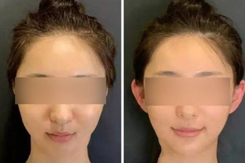 Trào lưu 'tai yêu tinh' kỳ dị của giới trẻ Trung Quốc
