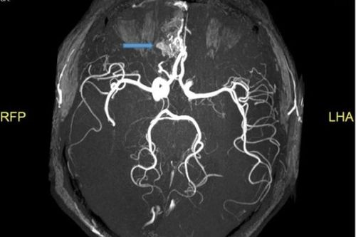 Phát hiện tổn thương não ở bệnh nhân COVID-19 qua MRI