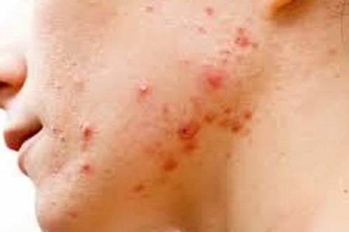 Cách chữa đơn giản bệnh viêm nang lông rất khó chữa, tốn tiền lại rất hay gặp bằng dược liệu
