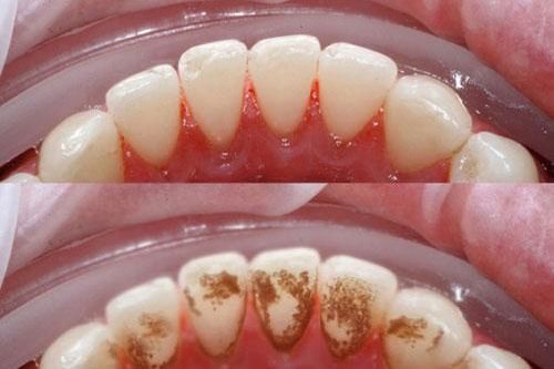Dùng 1 chiếc bánh mỳ cao răng bao nhiêu cũng bong sạch