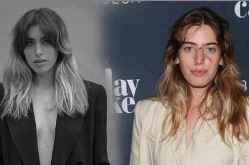 Diễn viên Hollywood gây hoang mang vì mang gương mặt vừa bị chó cắn chảy máu lên thảm đỏ