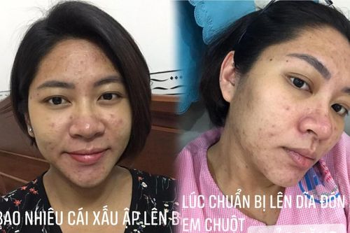 Hoa hậu Đại dương Đặng Thu Thảo khiến dân tình 'phát hoảng' với gương mặt mọc đầy mụn