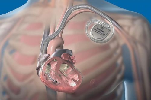 Máy ICD sắp cấy vào cơ thể Eriksen hoạt động ra sao