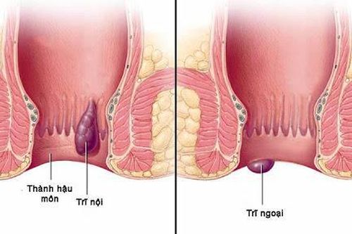 Bệnh trĩ là gì? Dấu hiệu, nguyên nhân và cách khắc phục?