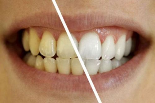 Cách đơn giản để giải quyết răng ố vàng bạn phải biết