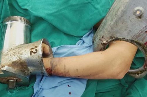 Bất cẩn, người phụ nữ bị máy xay thịt nghiền nát 4 ngón tay