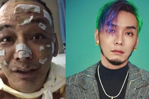 Nam rapper Từ Chân Chân bị bỏng nặng, mặt biến dạng