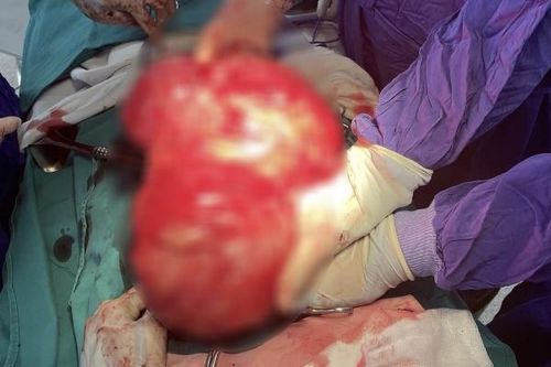 Sau 2 tháng đau bụng, sút cân, đi khám phát hiện ra khối u khủng