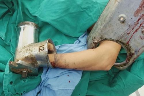 Do sơ sẩy người phụ nữ đến viện cấp cứu khi tay trong máy xay giò chả