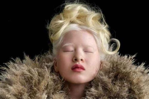 Cô gái bạch tạng bị bỏ rơi từ bé lớn lên nổi tiếng không ngờ