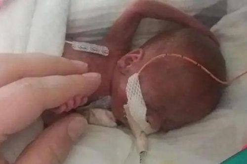 Sinh nhật đầu tiên của e bé sinh non nhất thế giới chỉ nặng hơn 300 gram