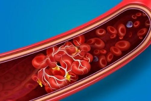 Xác định nguyên nhân COVID-19 gây các cục máu đông đe dọa tính mạng