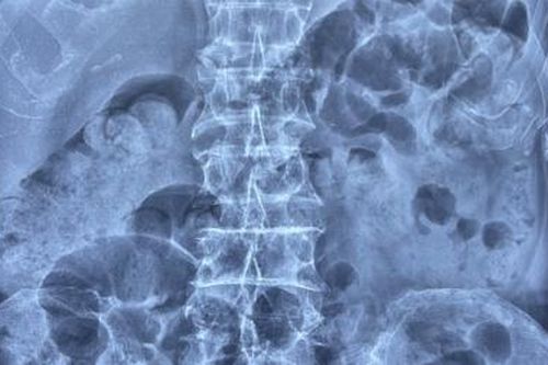 Lần đầu tiên thực hiện thành công đặt stent điều trị ung thư đại trực tràng tại phía Nam