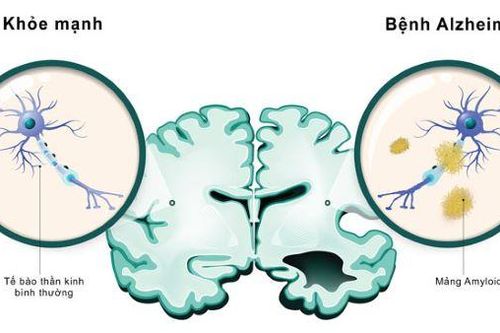 Nghiên cứu vắc-xin chống lại bệnh Alzheimer