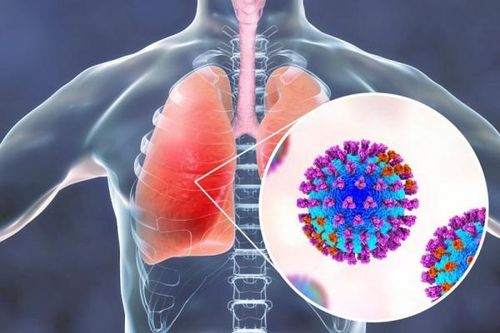 Nguyên nhân dẫn đến viêm phổi nghiêm trọng ở bệnh nhân COVID-19