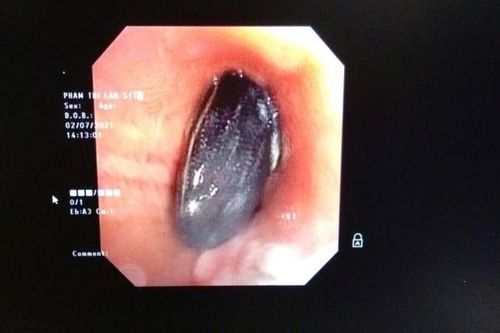 Hạt hồng xiêm trong phổi người phụ nữ gần 1 năm