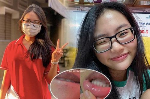 Thi cử căng thẳng, Phương Mỹ Chi chụp cận cảnh làn da 'toang mạnh' ai nấy đều thương