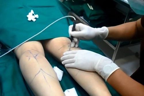 Đánh cược tính mạng, cắt dây thần kinh để có chân thon
