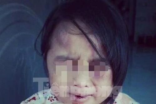 Cha về quê, con bị cô và dượng đánh đập tàn bạo