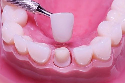 Quy trình bọc răng sứ đúng chuẩn nha khoa nhất hiện nay