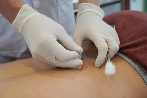 Cấy chỉ chữa đau lưng tại phòng khám chui, bệnh nhân bị nhiễm trùng