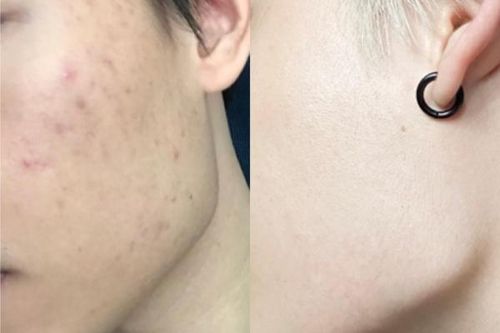 Quang Trung làm dân mạng ngỡ ngàng về làn da 'ngày ấy – bây giờ'