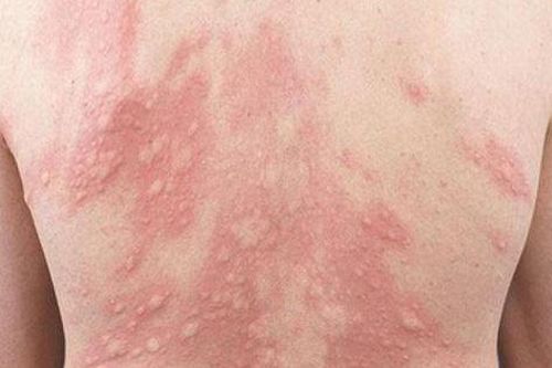 Nổi mề đay- Do đâu?