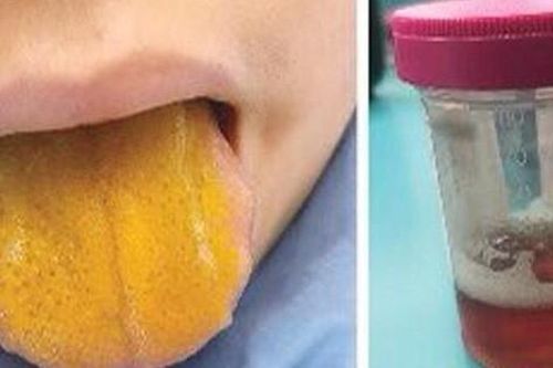 Bác sĩ cũng sốc khi thấy lưỡi cậu bé 12 tuổi chuyển thành màu vàng, nước tiểu sẫm màu