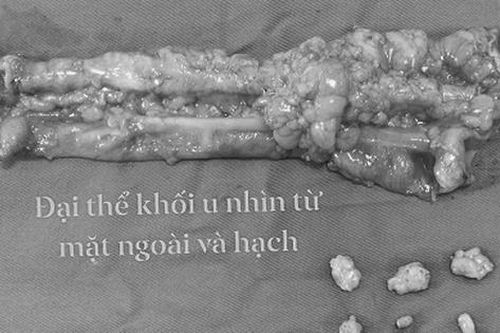 Đau bụng kéo dài, đại tiện khó có thể do ung thư đại tràng